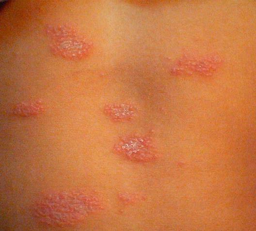 Differential Diagnosis: Pityriasis