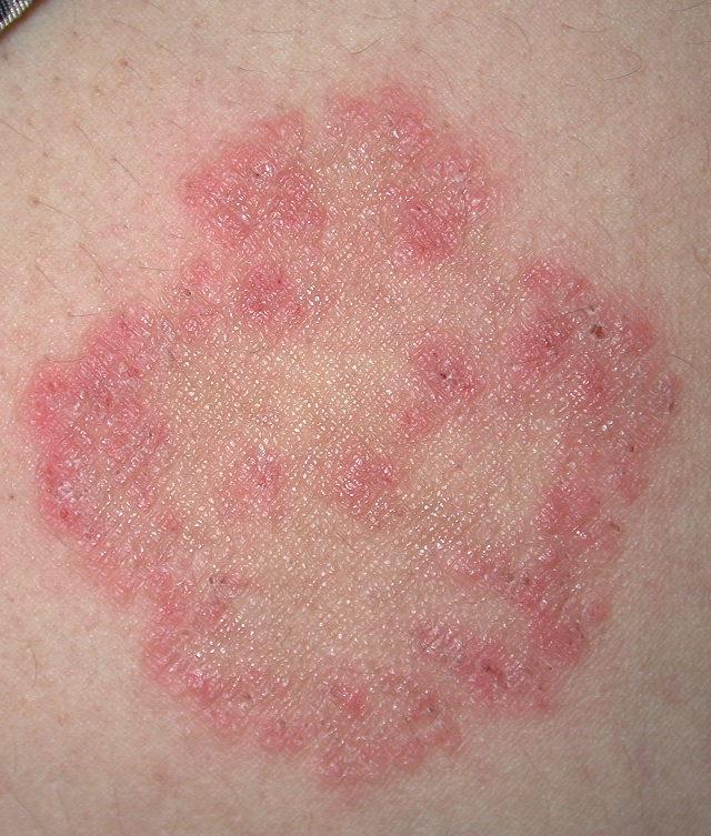 Clinical Signs/Symptoms of Tinea Corporis Annular erythematous plaques with a raised leading edge and scaling Central clearing may be visible in plaques Other possible