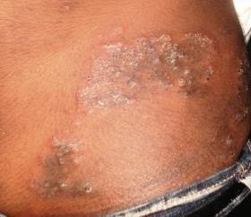 Clinical Signs/Symptoms of Tinea Corporis Lesions appear on glabrous skin (skin normally devoid of hair) of the torso, legs, and arms Tinea of the scalp, face, groin,