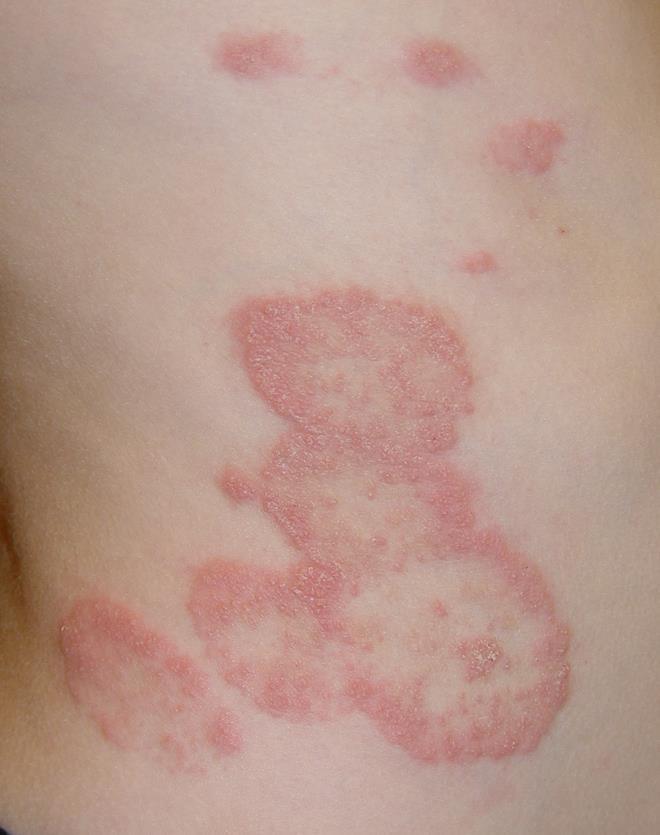 Other Red, Scaly Lesions Tinea