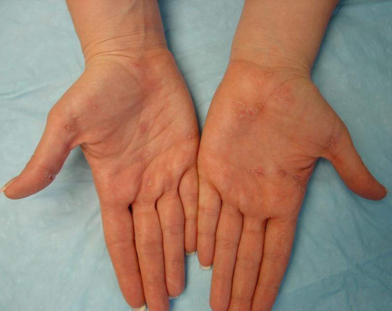 Clinical Signs/Symptoms of Secondary Syphilis Nonpruritic, pink or dusky red rash on the trunk, palms, and soles, in a symmetric pattern Lesions often occur along with superficial scale, or they may