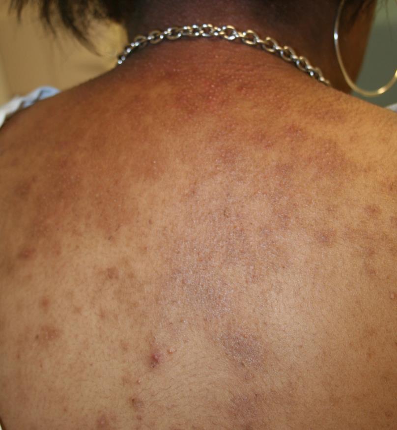 Eczema Photo at left: Danderm; www.danderm-pdv.
