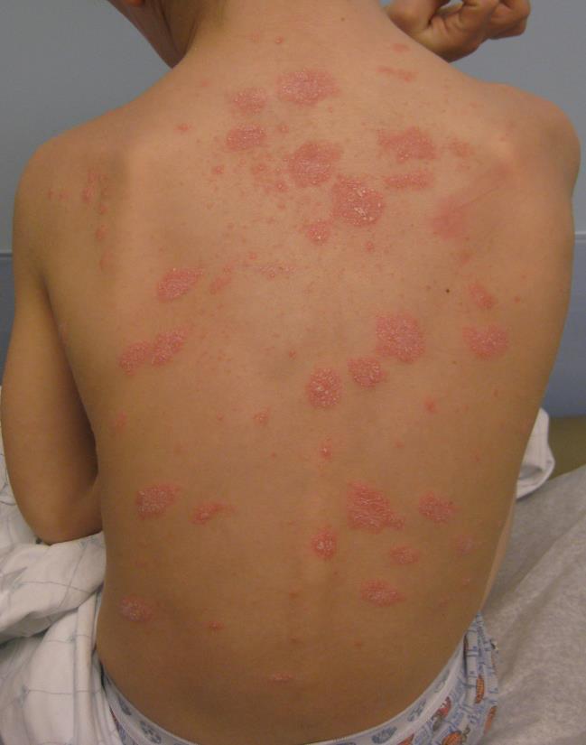 Other Red, Scaly Lesions Cutaneous