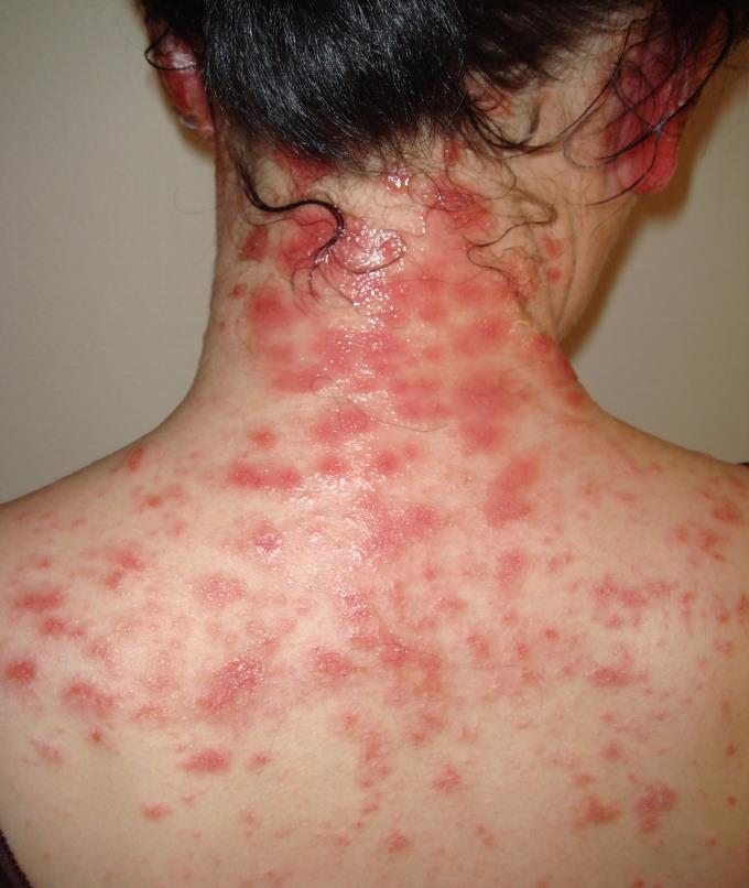 Differential Diagnosis: Cutaneous