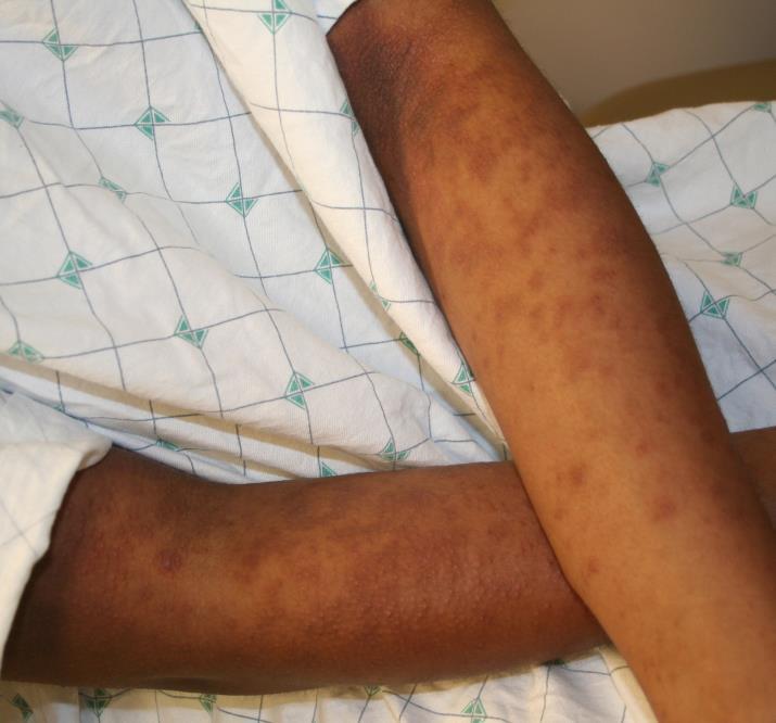 Differential Diagnosis: Cutaneous