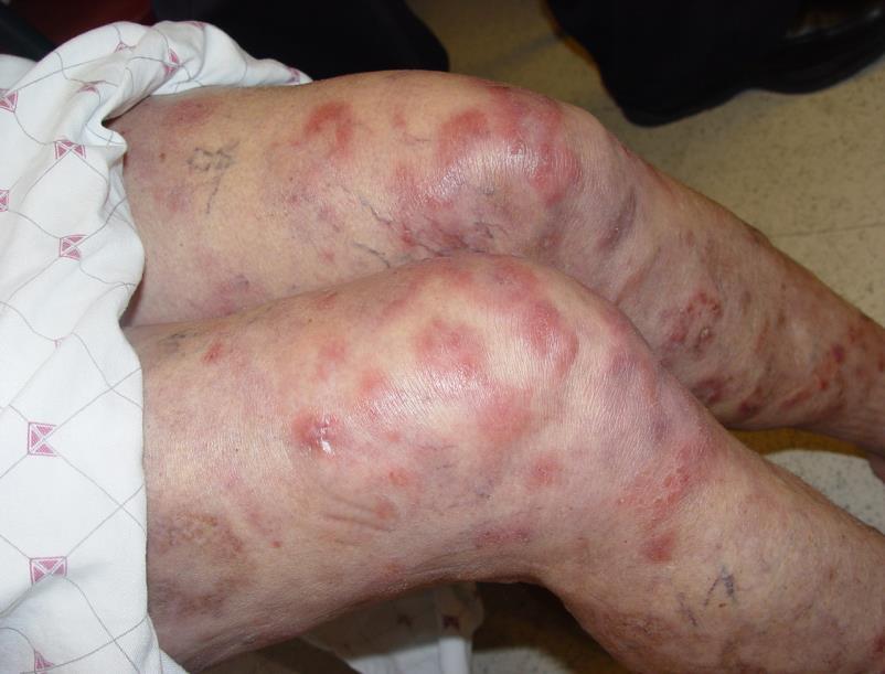 Other Red, Scaly Lesions Cutaneous
