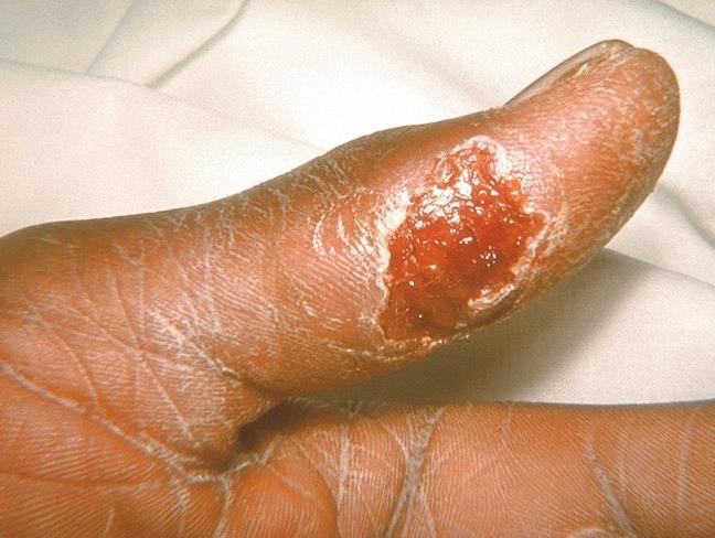 Depressed Lesions Ulcer
