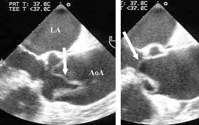 Type A Aortic