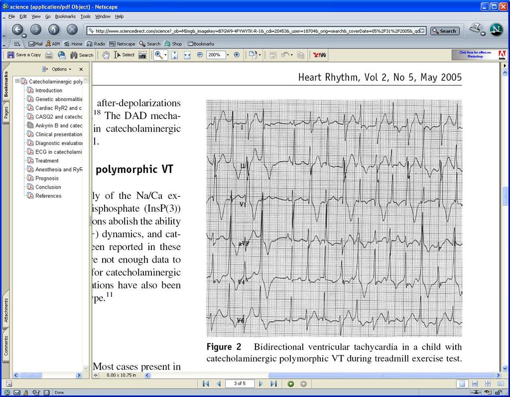 Familial catecholaminergic polymorphic VT: Bidirectional VT in a