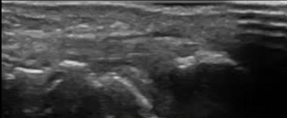 Role of Magnetic Resonance Imaging (H) (I) (H,I) longitudinal ultrasound images showing carpal erosions DISCUSSION Rheumatoid arthritis (RA) is an inflammatory disease of unknown cause.