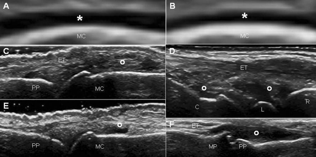 Joint and tendon ultrasound in SLE / A. Delle Sedie et al. IMAGING Fig. 1. Systemic lupus erythematosus.