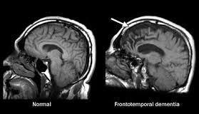 Frontotemporal Dementia Often seen in patients with onset of cognitive symptoms at a younger age Shrinking of the frontal and temporal regions; most common in men Executive and language dysfunction