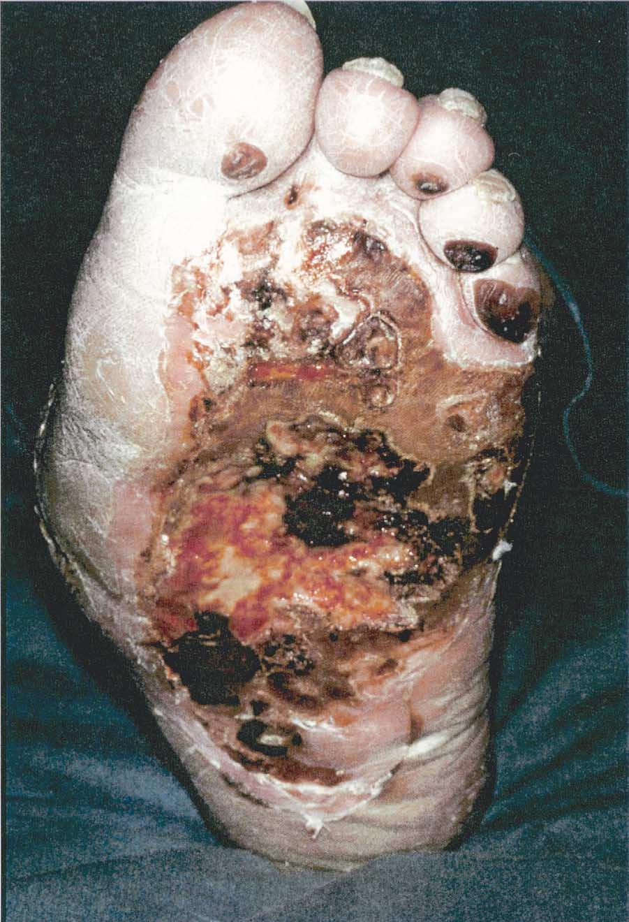18S A.J.M. Boulton / The American Journal of Surgery 187 (Suppl to May 2004) 17S 24S Fig. 1. The dangers of insensitivity.