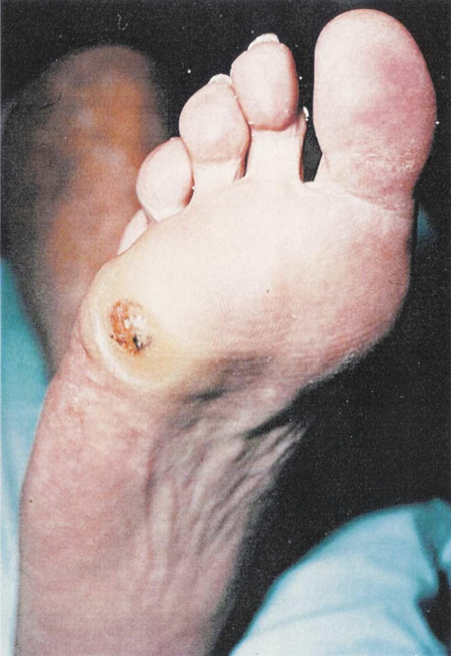 20S A.J.M. Boulton / The American Journal of Surgery 187 (Suppl to May 2004) 17S 24S Fig. 2. Preulcerative lesion.