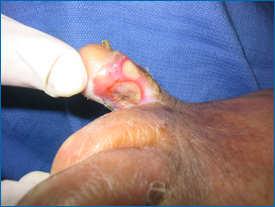 contributing factor in diabetic foot ulcers 1-7 Other factors: foot deformity, callus, trauma, and peripheral vascular