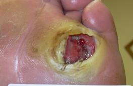 Foot ulcers in patients with diabetes can be classified as neuropathic, neuroischemic, or ischemic however there is