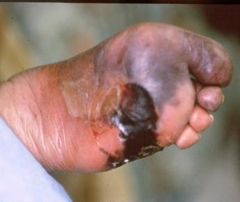 Wagner Classification Diabetic Foot Ulcers Grade 0: Intact skin Grade I: Superficial without penetration deeper layers Grade II: Deeper reaching tendon, bone, or joint capsule