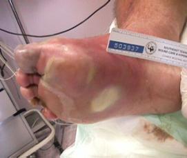 involving the whole foot or enough of the foot that no local procedures are possible Grade I & II w/infection = Grade III Wagner Grade IV Gangrene of some portion of the toe,