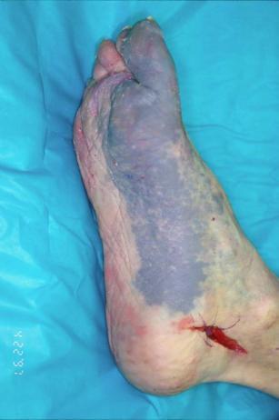 foot despite the occlusion of one or more arteries (vascular redundancy;