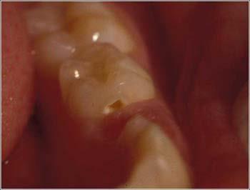 S Mutans S. mutans is concentrated in the pits and fissures of teeth, so the grooved surfaces of the molars are the most common site for caries lesions.