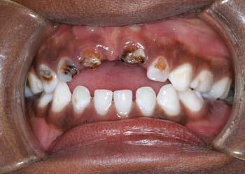 Affected Teeth ECC tends to affect the upper (maxillary) incisors first because they erupt earliest and are less protected by saliva.