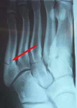5th Metatarsal Fracture 4Are they all the same?