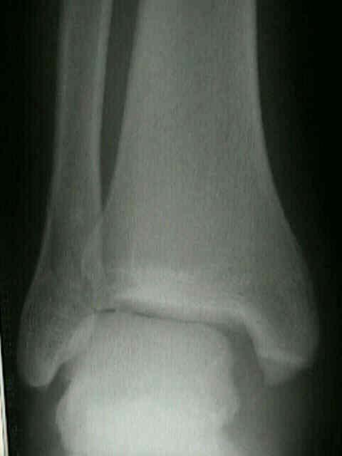 Lateral Malleolus Fractures 4Are they all the same?