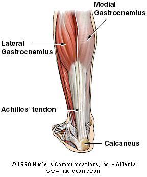 Medial Gastrocnemius Muscle Tear 4Pain is higher, mid to