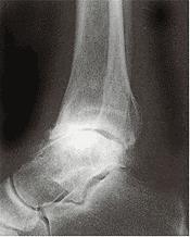 Ankle Arthritis 4Rare.