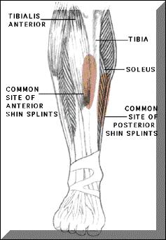 Overuse of Bone 4Shin Splints: medial tibial stress syndrome Sore after stopping