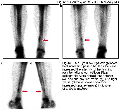 Overuse of Bone Stress Fracture 4Often young, woman, runner 4Sudden increases in