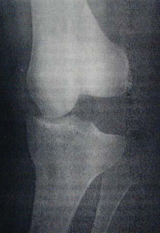 Knee dislocation Lateral Valgus injury