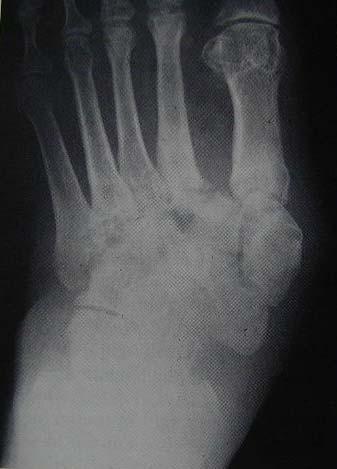 Neuropathic fractures Charcot joint Associated with DM, peripheral nerve diseases Initiating event is fracture around the joint