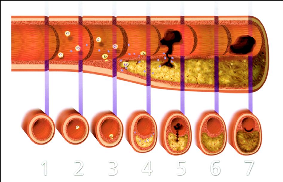 Atherosclerotic Plaque: Arterial remodeling AHA type of atherosclerotic plaque of coronary artery Peter Libby. Current Concepts of the Pathogenesis of the Acute Coronary Syndromes. Circulation.
