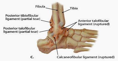 SPECIAL TESTS MUDLER S CLICK The examiner grasps the heads of the first and fifth metatarsal heads Compresses them together Fingers at the web space Pain may be elicited In 40% click may be felt