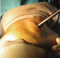 The guidewire exits the sinus tarsi medially, just inferior and anterior to the tip of the medial malleolus.