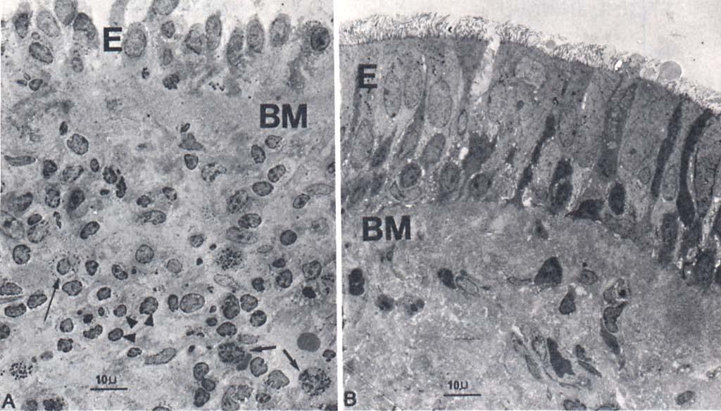 Effects of Inhaled Corticosteroids on Inflammation E = Epithelium BM = Basement Membrane Pre and post