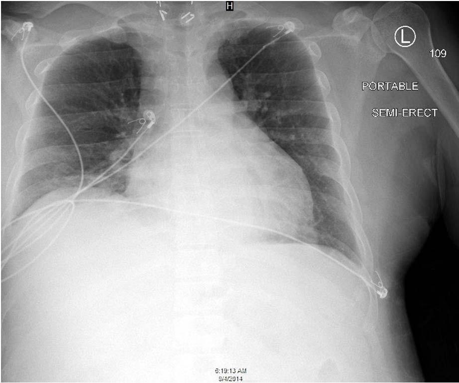 Differential Diagnosis What is the differential diagnosis in a patient with Bilateral Nodular parenchymal disease Bilateral Pleural