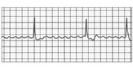 Atrial flutter rapid rate of atrial depolarization Defects Fibrillation Defibrillator shocks heart to interrupt irregular contractions; hopefully SA node fires & sinus rhythm is reestablished AED