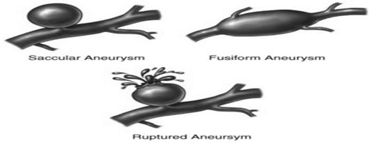 Aneurysm Occurs when part of a blood vessel swells due to damage or weakness. As blood pressure builds up it balloons out at its weakest point.