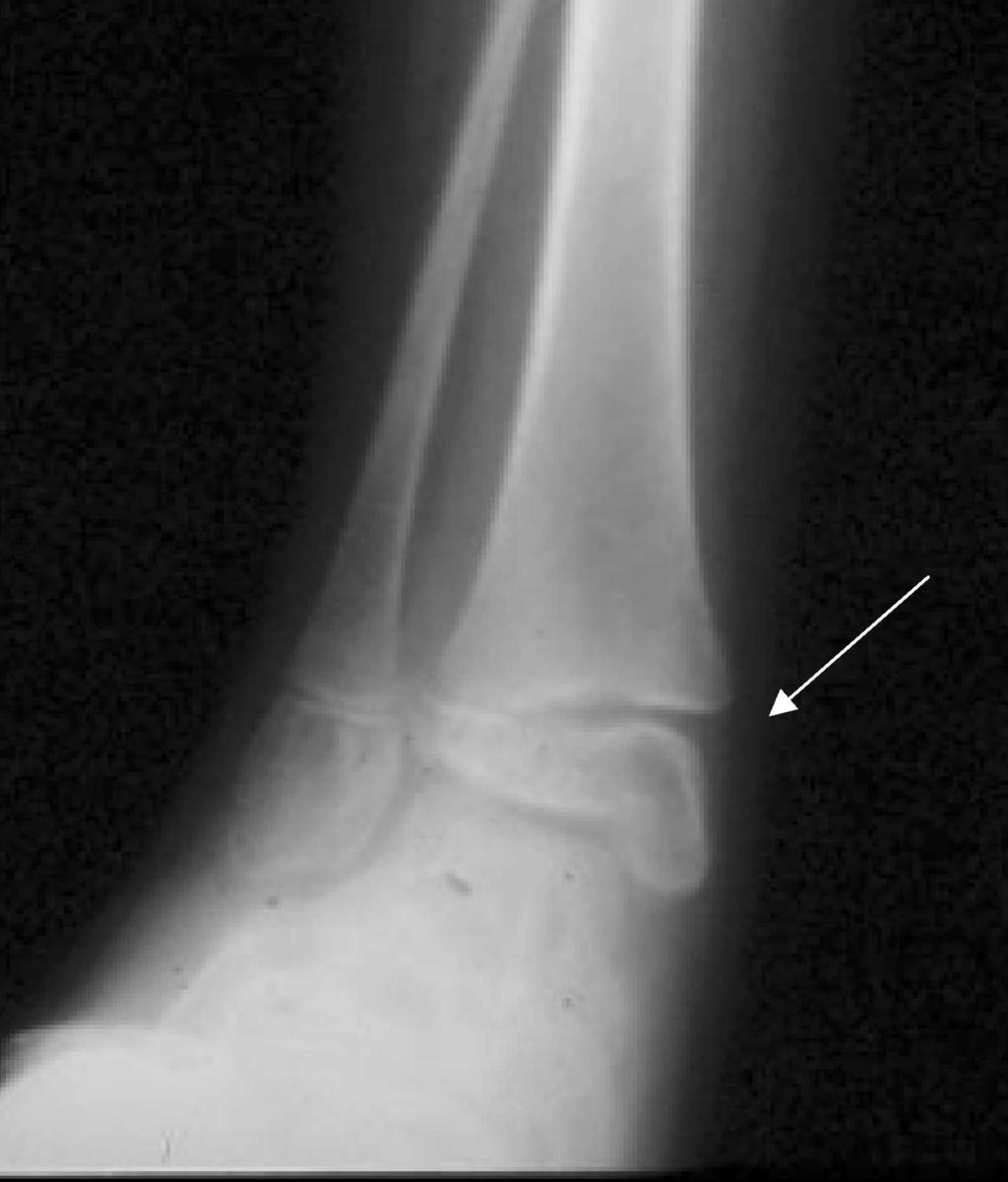 January March 2007 Vol. 29, No. 1 Salter-Harris Fractures 13 observation from the orthopedic physician is indicated. Type IV This fracture involves the epiphysis, physis, and metaphysis.
