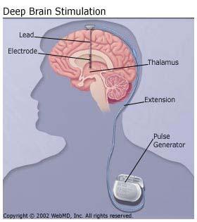 Deep Brain Stimulation Update on Deep Brain Stimulation Current indications are for PD, ET, and generalized dystonia Trials ongoing into early treatment When first see motor fluctuations Frameless
