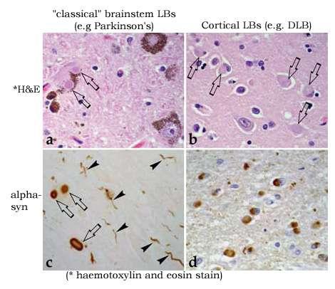 Lewy Bodies Histological analysis of PD brains reveals inclusion bodies in dopaminergic neurons, known as