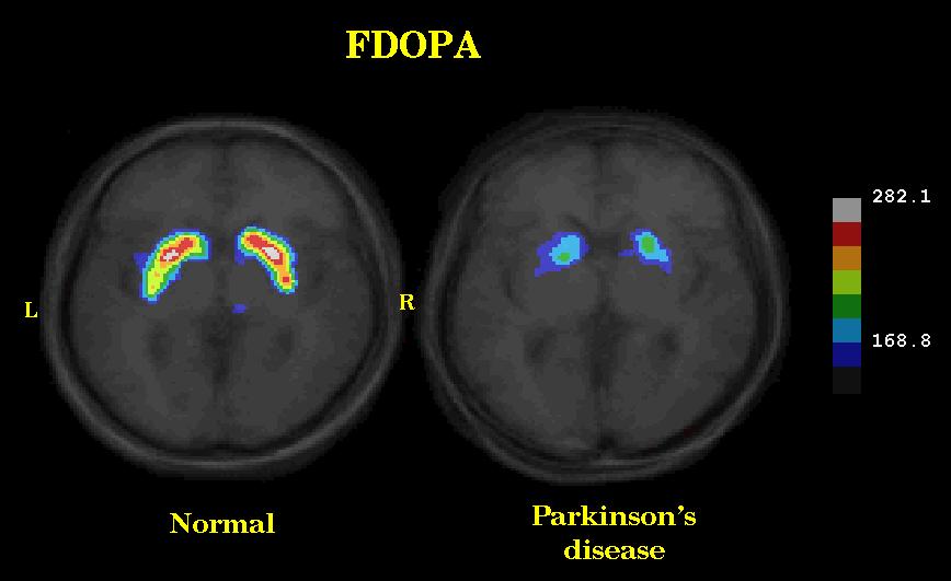 PET Scan Reveals Loss of Dopamine Receptors in the Brain Injecting patients with 18 F-dopamine allows quantification of