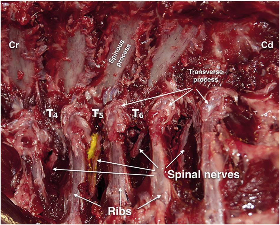 intercostal muscles and the parietal pleura (Fig. 2). Therefore, the echographic TPV space was defined as the space contained between the internal intercostal membrane and the parietal pleura (Fig.