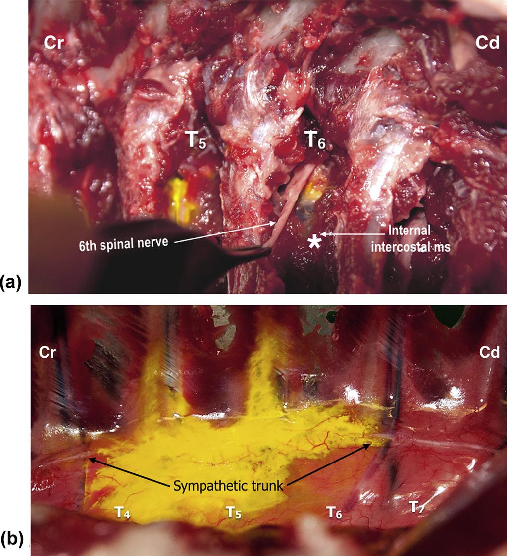 Figure 4 Dissection of the T 5 and T 6 thoracic paravertebral (TPV) spaces in a dog after injection of yellow dye using an ultrasound-guided TPV approach at the level of T 5.