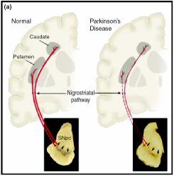 PD-Pathology Loss of dopaminergic neurons of the substantia nigra Loss of