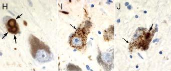 α-synuclein Other disease states Other neuron types Pathological role?