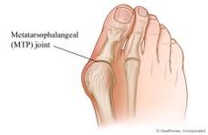 Patient Information: Big Toe Fusion Metatarsophalangeal (MTP) How is 1st MTP joint fusion carried out?