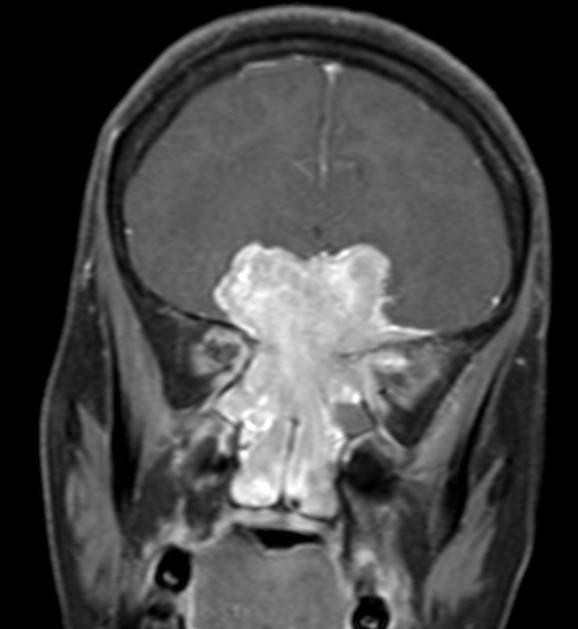 Estesioneuroblastoom Olfaktoorne neuroblastoom Difuusselt kontrasteeruv mass ninaõõne ülaosas